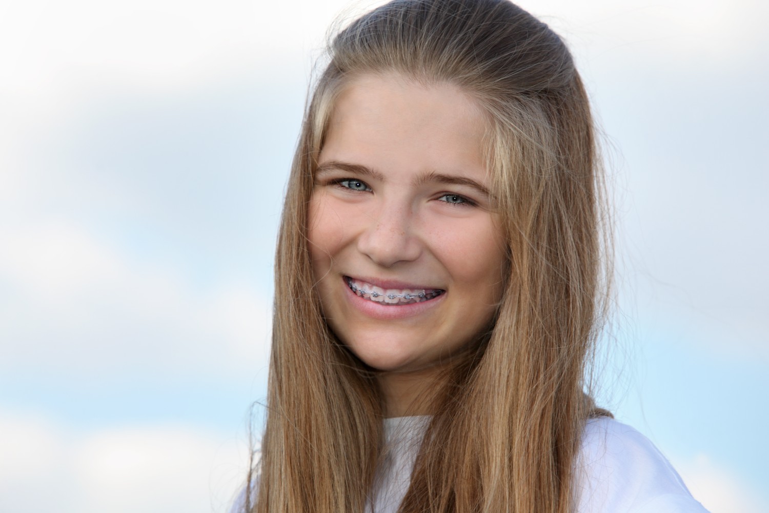 Benefits of Braces Besides Straight Teeth