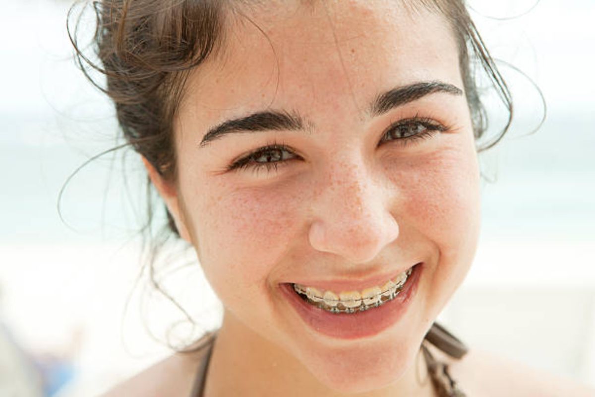 When Do I Get My Braces Off?