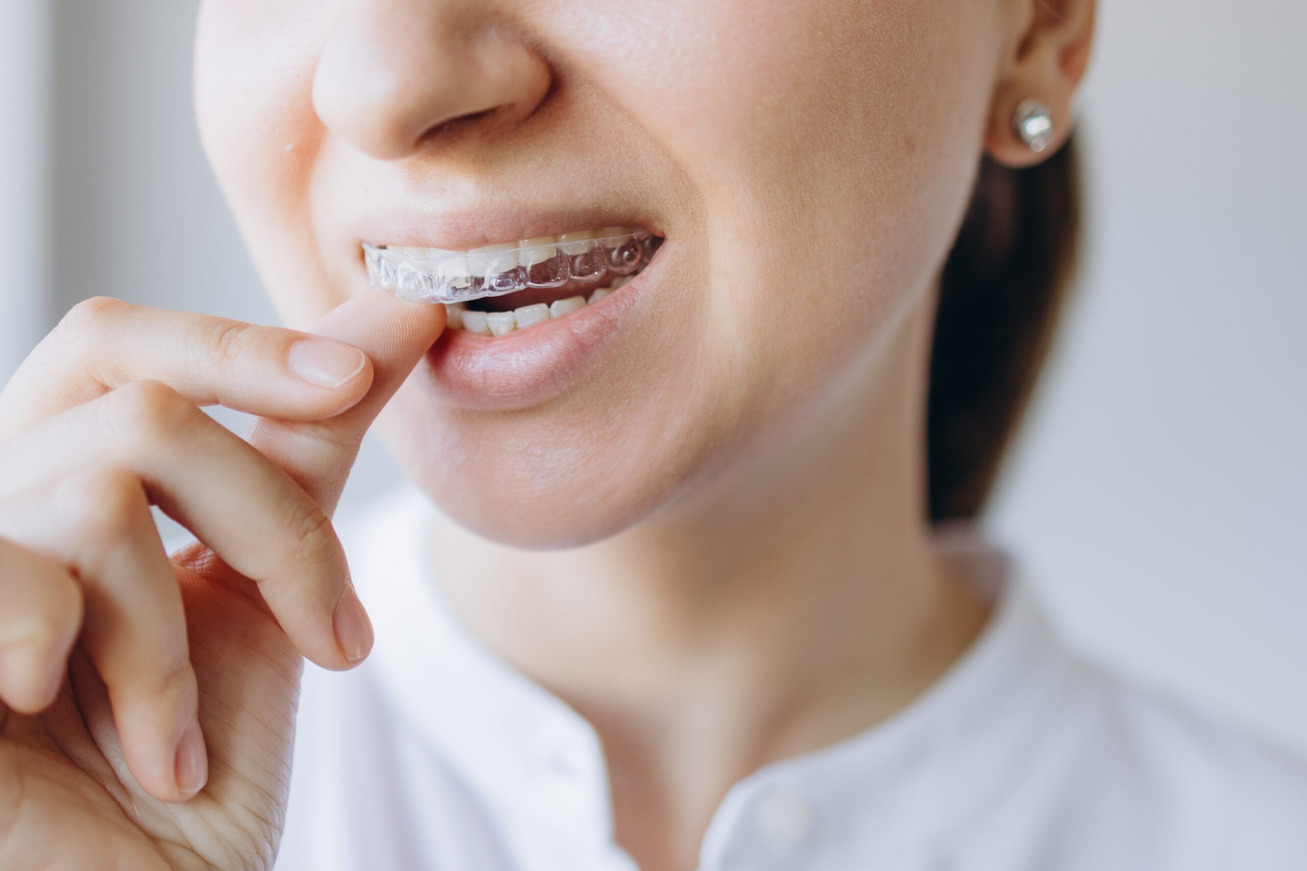 How Clear Aligner Technology Turns Digital Design into Real Results